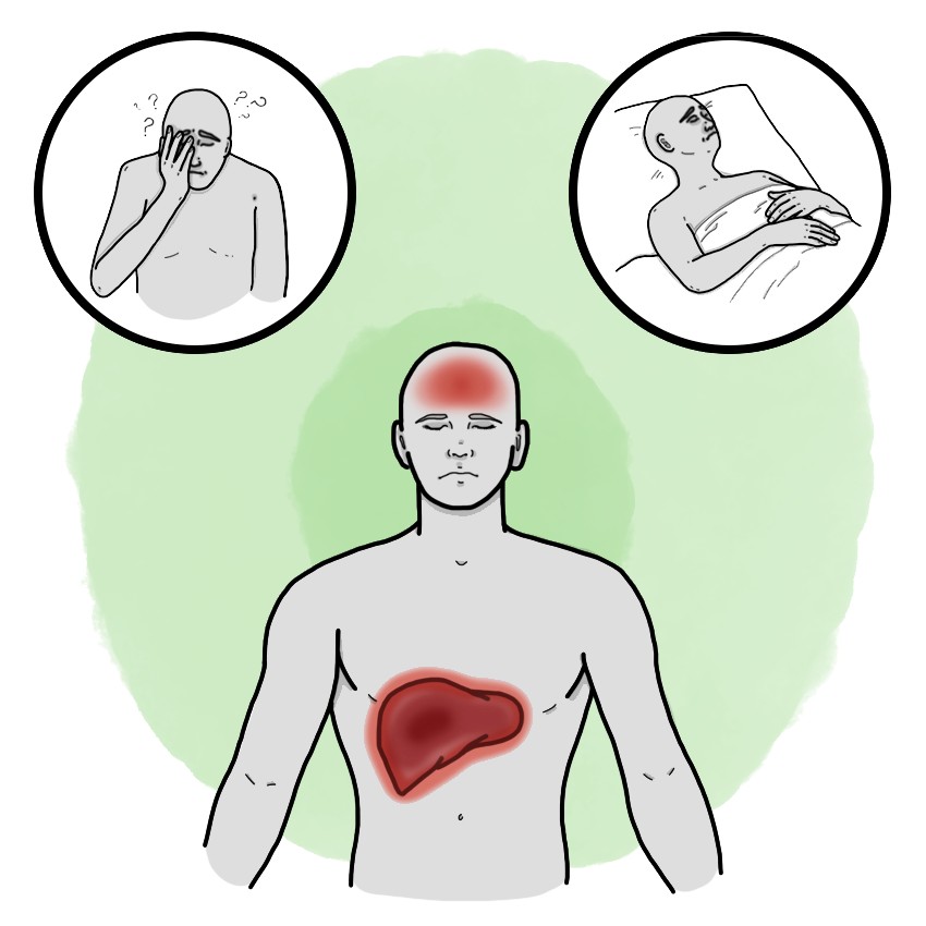 Hepatic encephalopathy grade III and IV