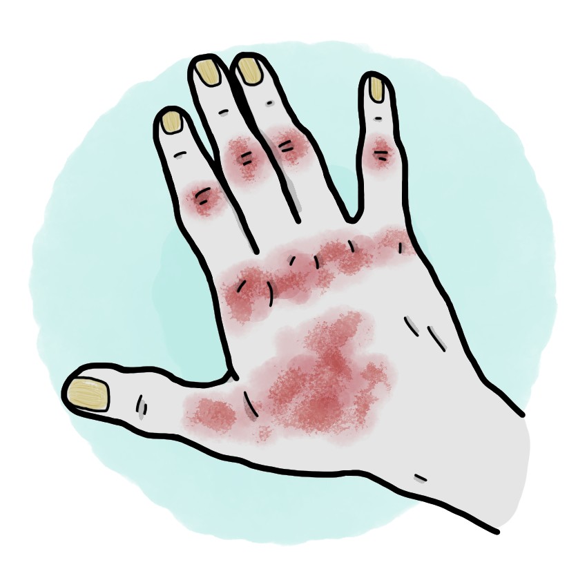 Psoriatic arthritis