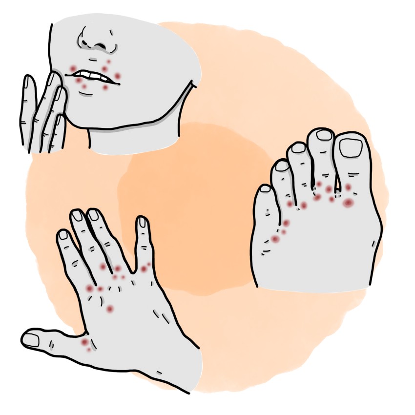 Hand-foot-and-mouth disease - Human aphthous fever (Paediatrics)