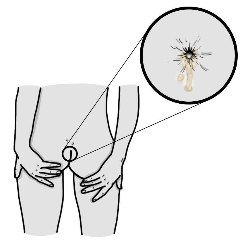 Pus no ânus