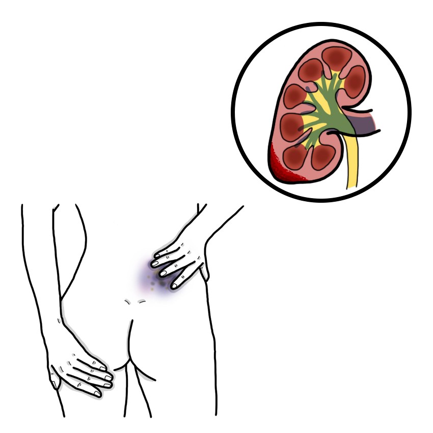 Trauma to the kidney