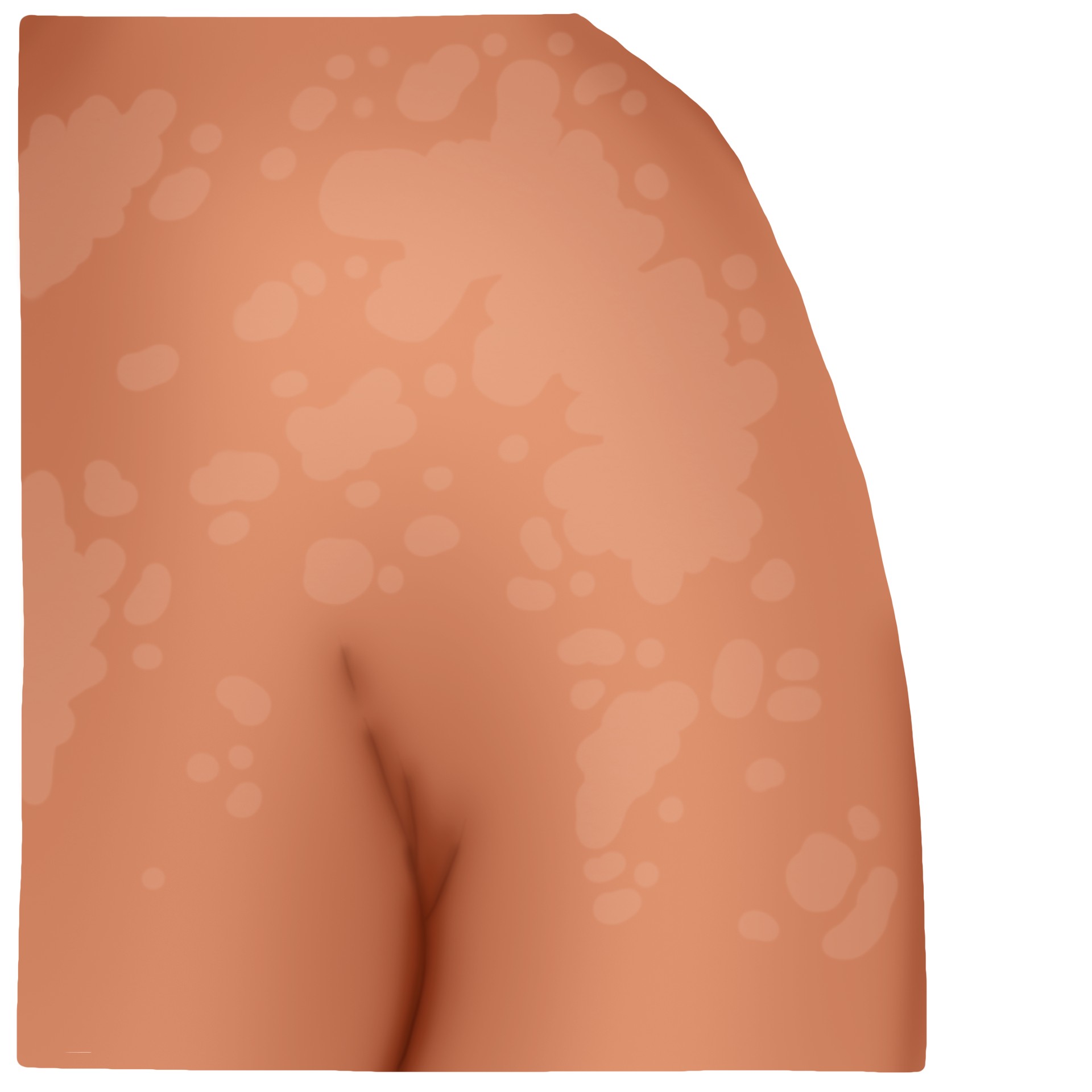 Tinea versicolor - Pityriasis (Paediatrics)