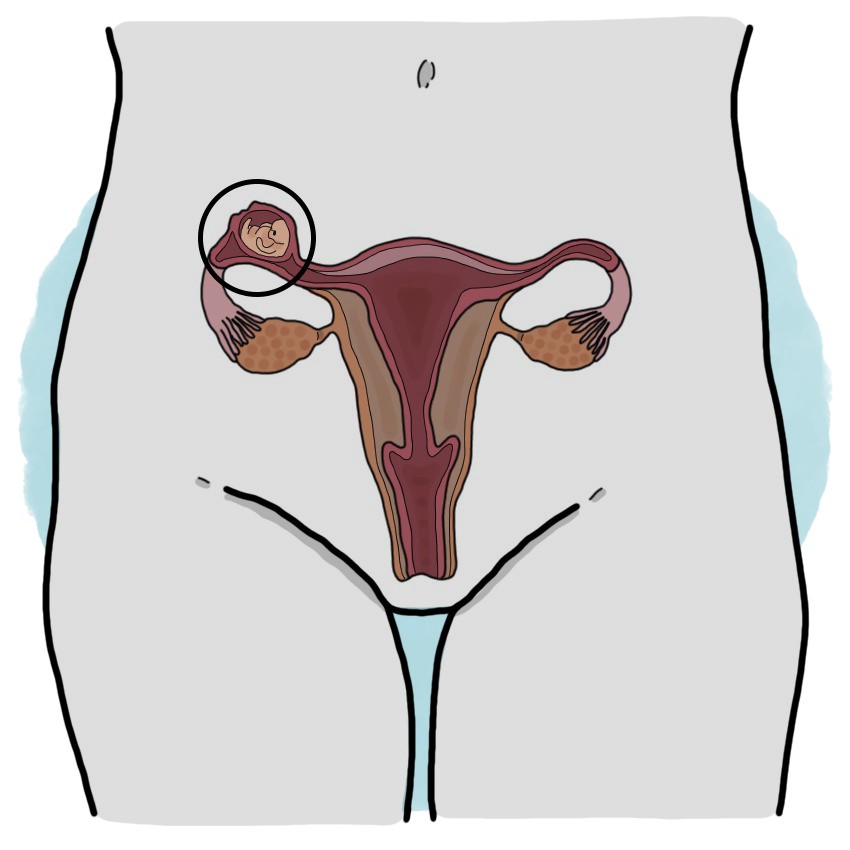 Ectopic pregnancy