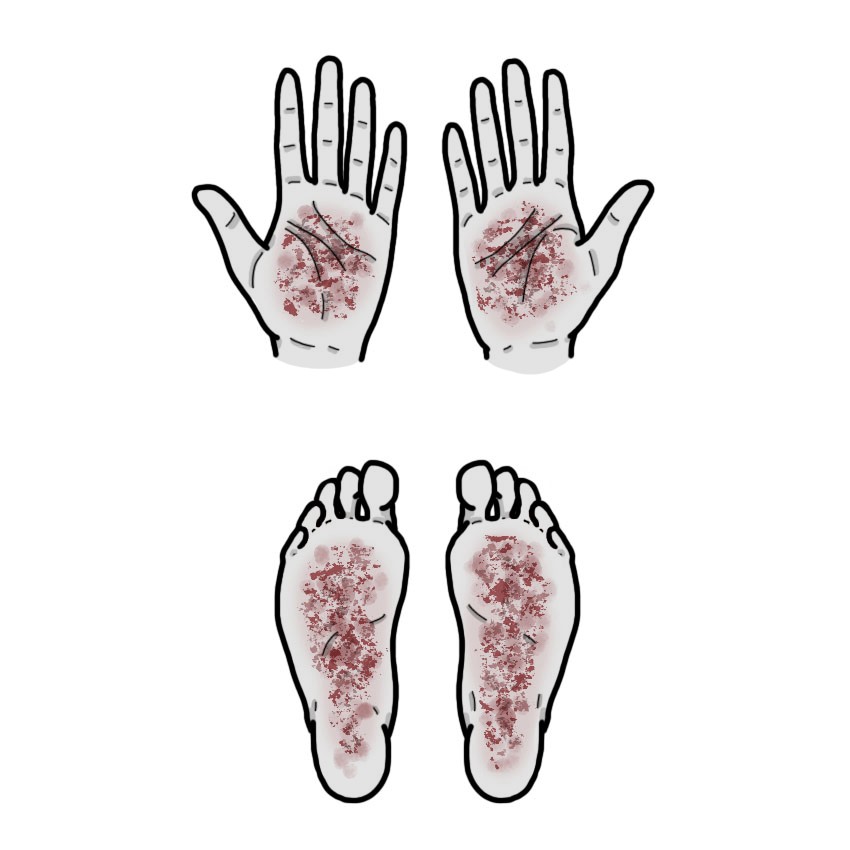 Rash in palms and soles