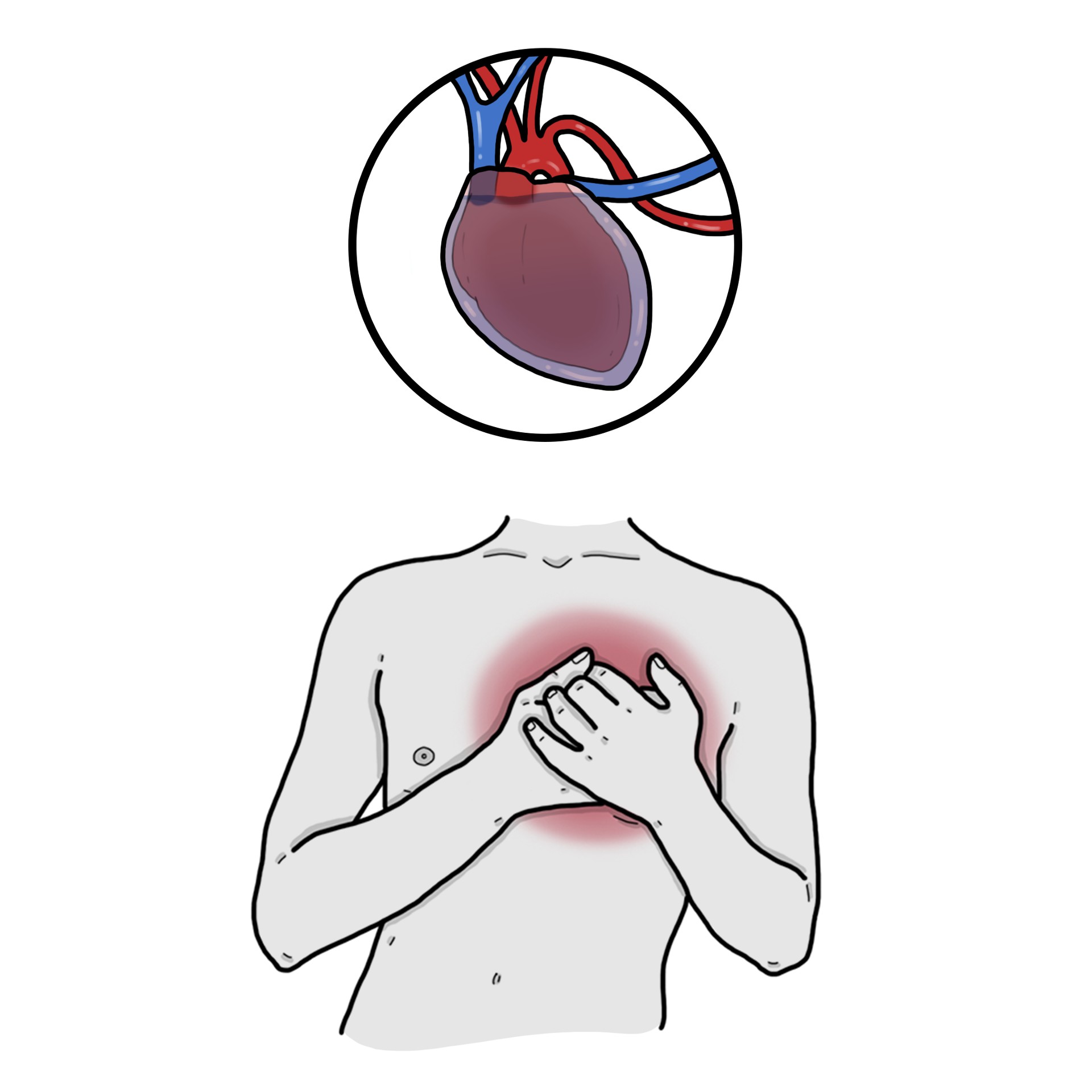 Taponamiento cardíaco