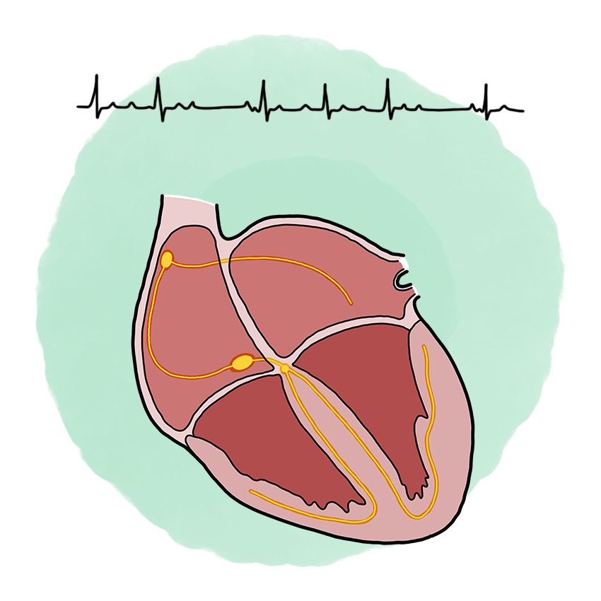 Möbitz-I second-degree atrioventricular block (Wenckebach)