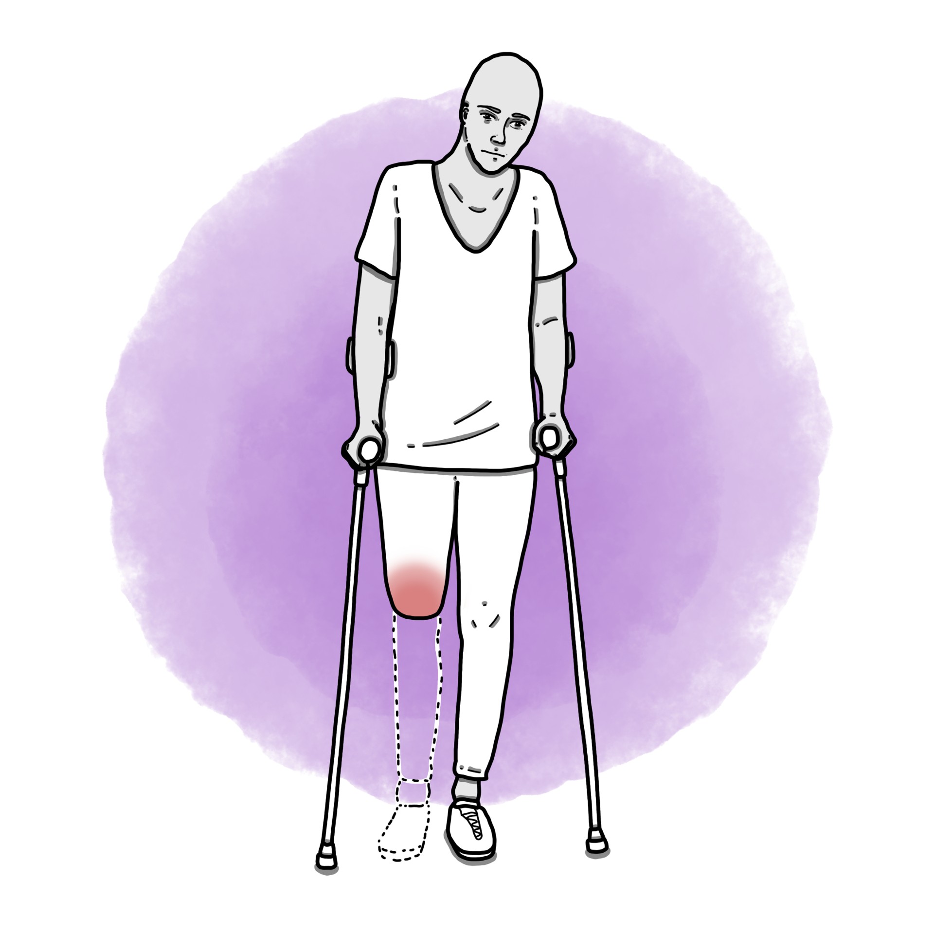 Phantom limb syndrome