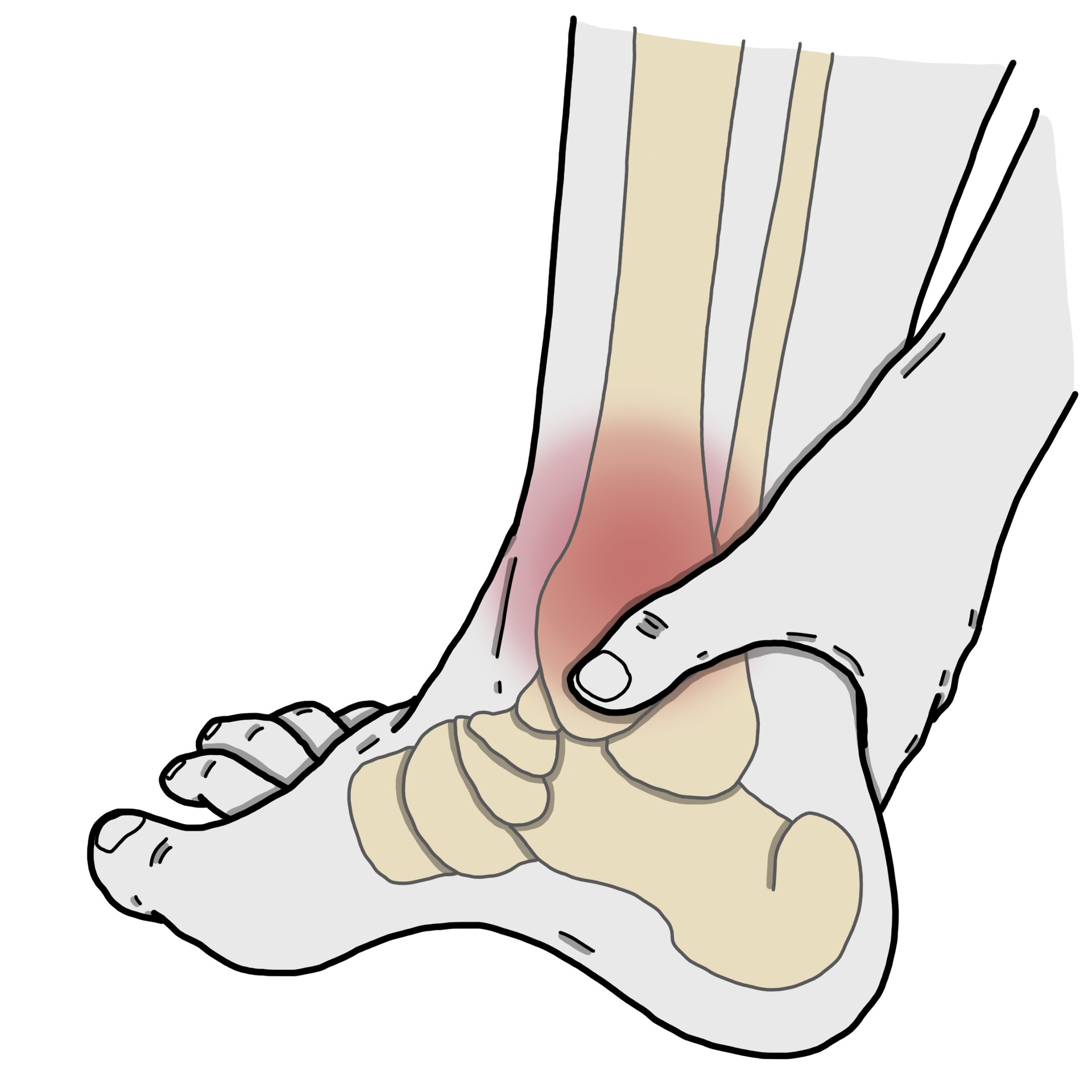 脛骨のくるぶし周辺、足首の内側に痛み