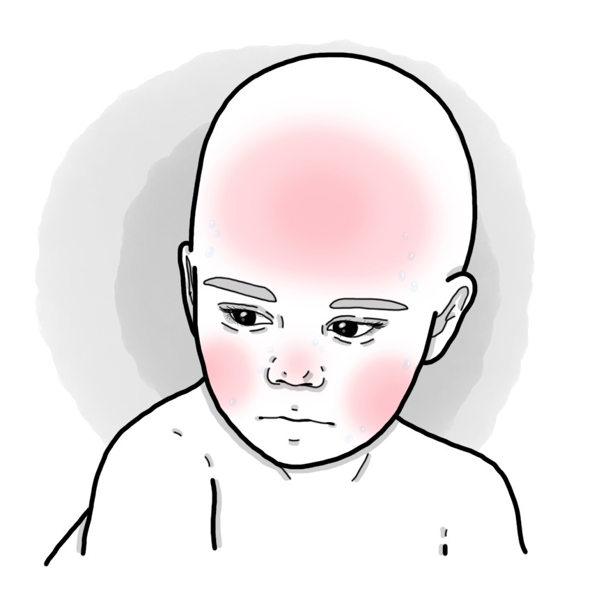 PFAPA syndrome (Paediatrics)