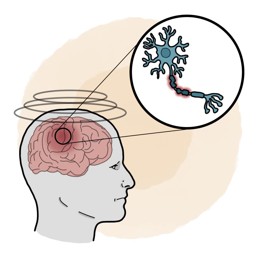 Central vertigo due to demyelinating disease - Central vertigo due to multiple sclerosis