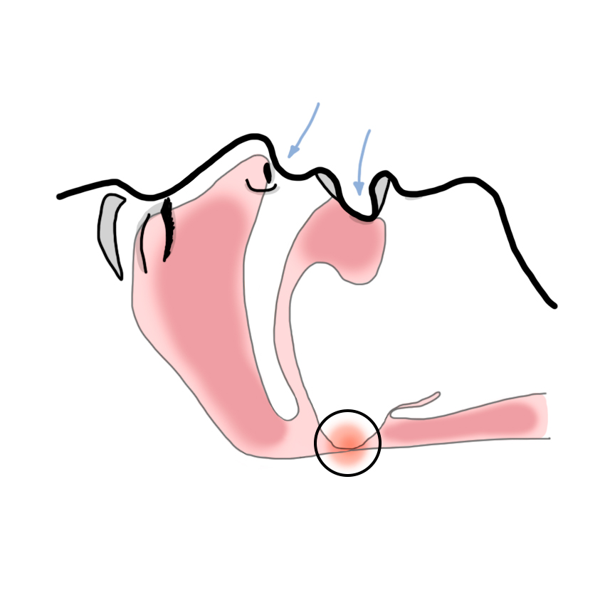 Obstructive sleep apnoea-hypopnoea syndrome - OSAHS