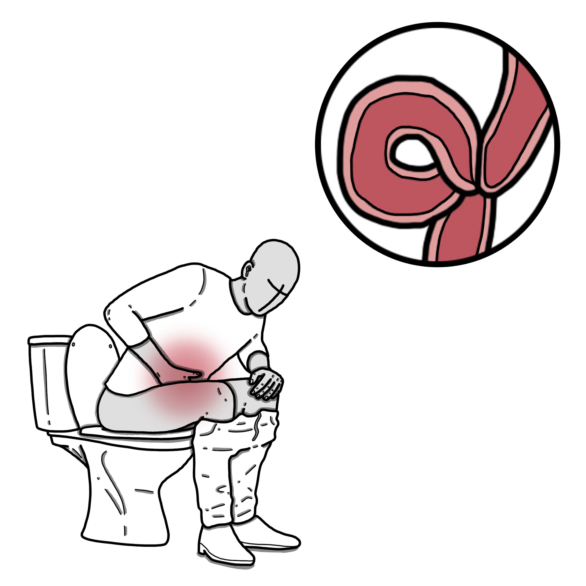 Mechanical Bowel Obstruction