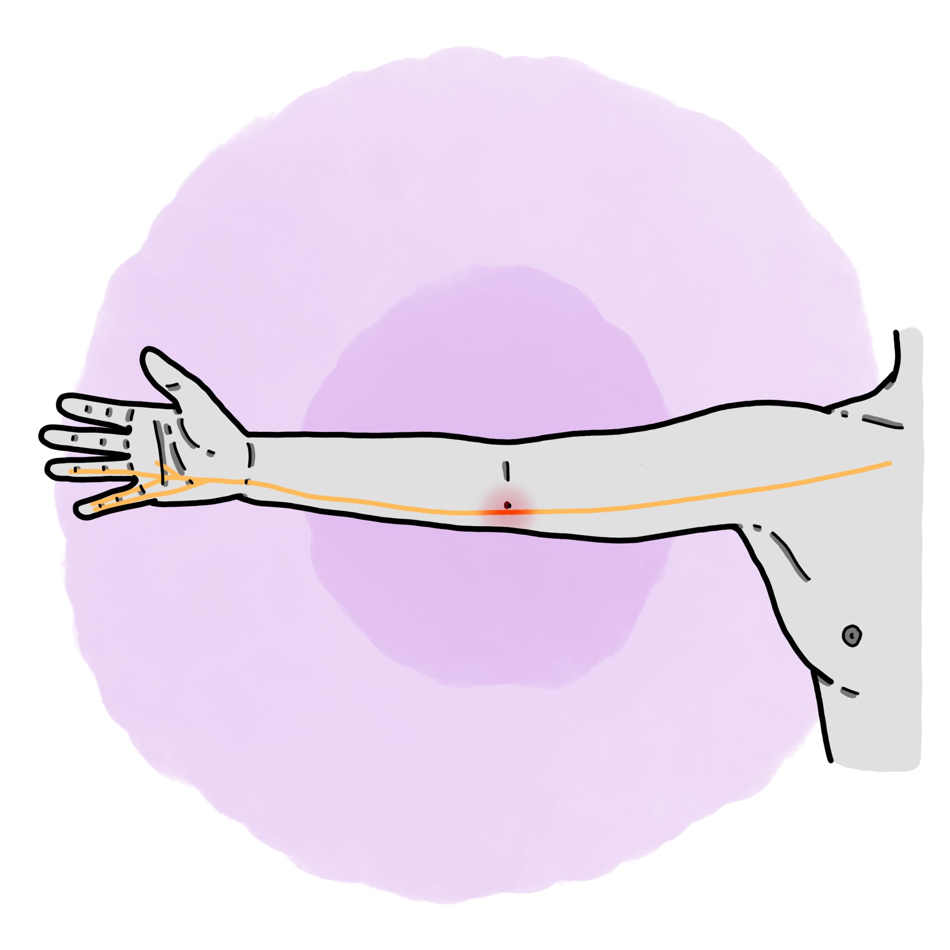 Ulnar nerve dysfunction - Cubital tunnel syndrome
