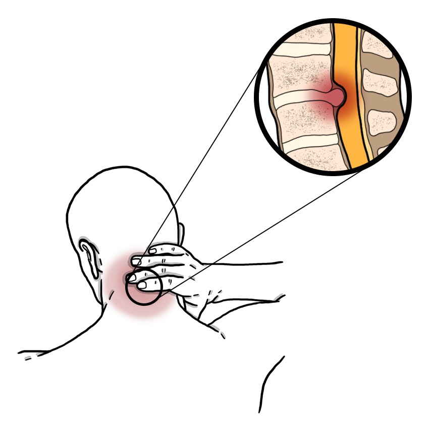 Cervical disc hernia - Cervical radiculopathy secondary to a slipped disc