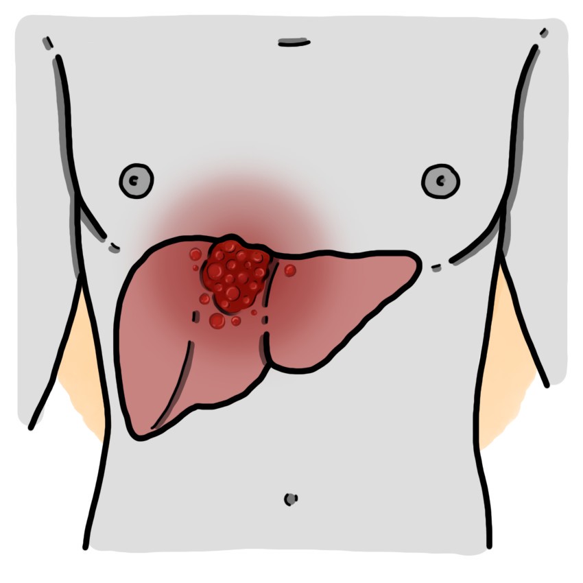 Liver cancer - Hepatocellular carcinoma