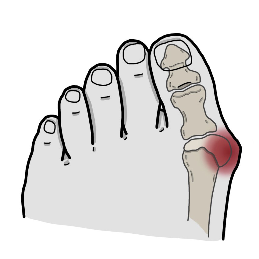 Bunion - Hallux valgus