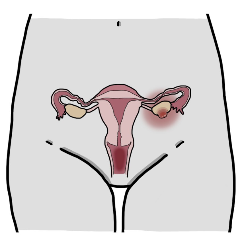Endometrial cyst