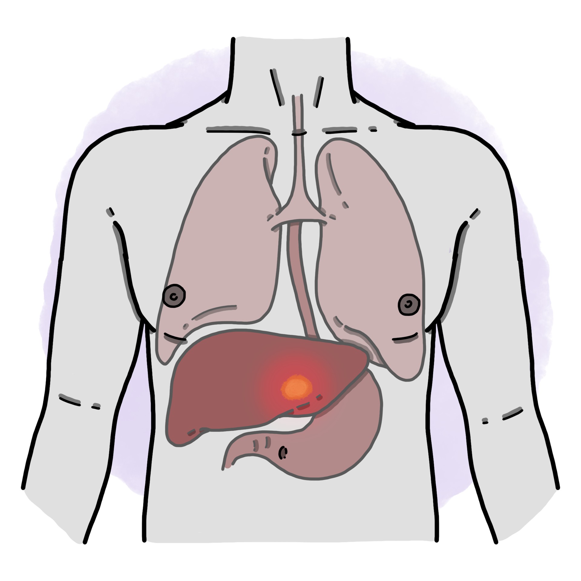 Liver abscess due to entamoeba histolytica
