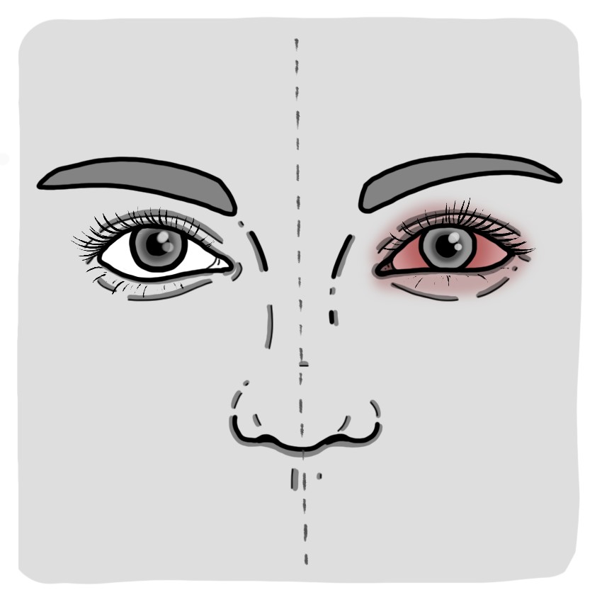 Allergic conjunctivitis