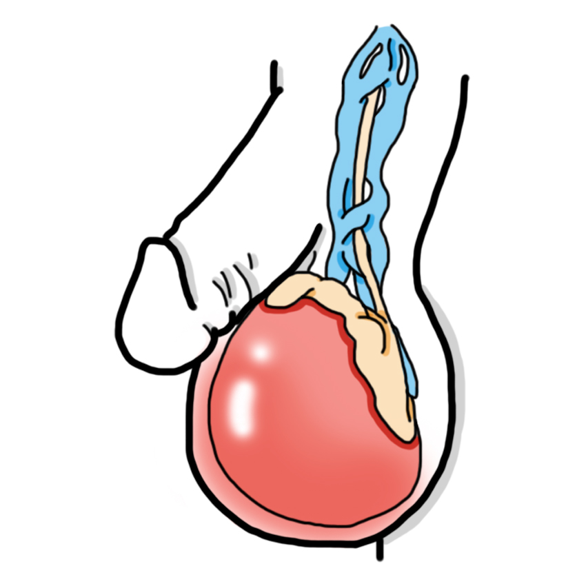 Testicle inflammation - Orchitis