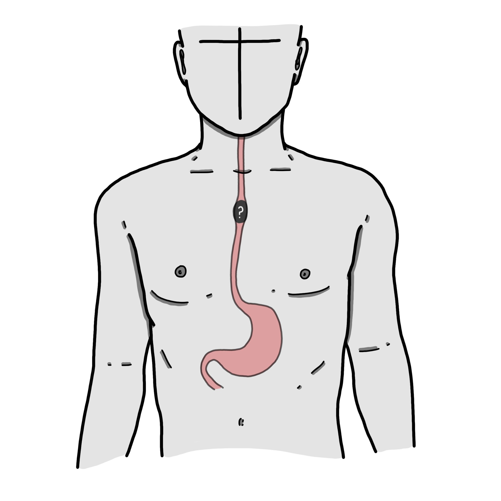 Object stuck in the oesophagus - Oesophageal foreign body