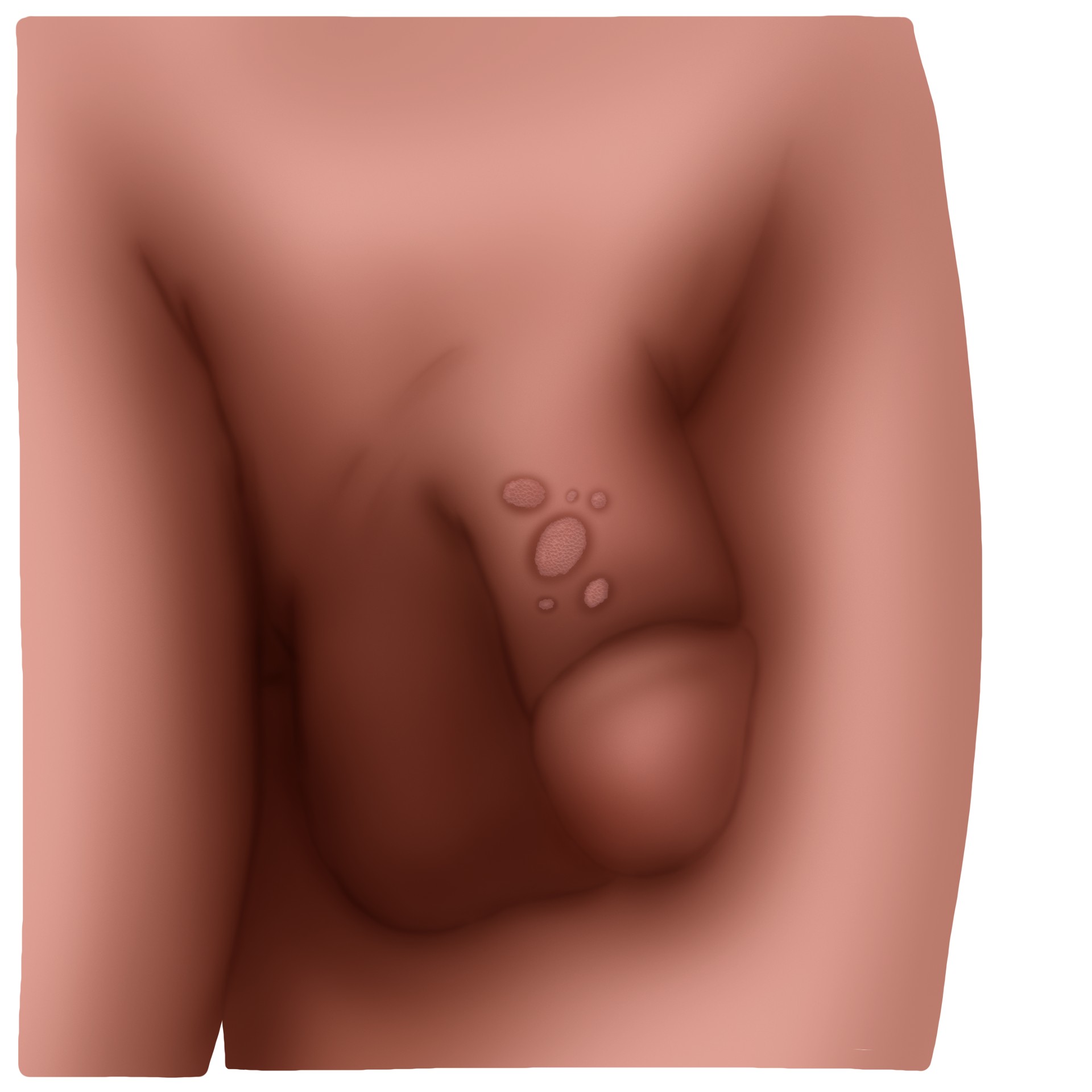 Genital warts due to human papillomavirus - Genital condylomas