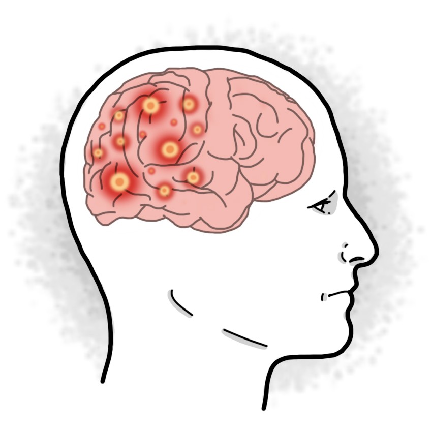 Simple partial epilepsy - Simple partial seizures