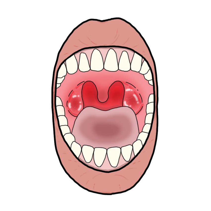 Viral tonsillopharyngitis (Paediatrics)