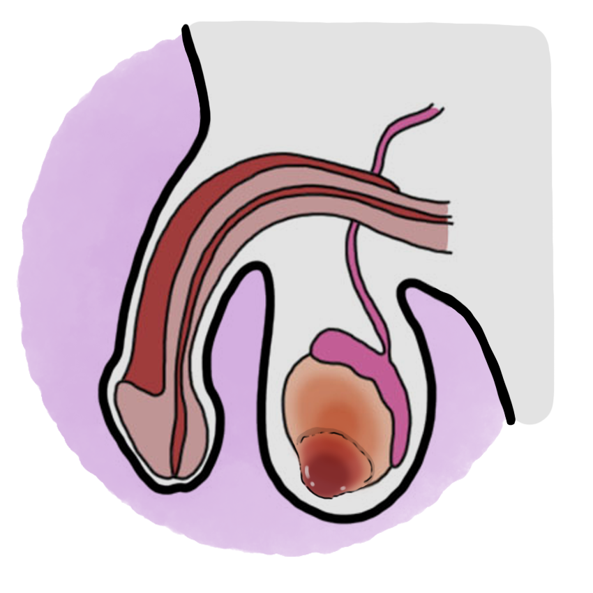 Testicular cancer - Testicular neoplasia