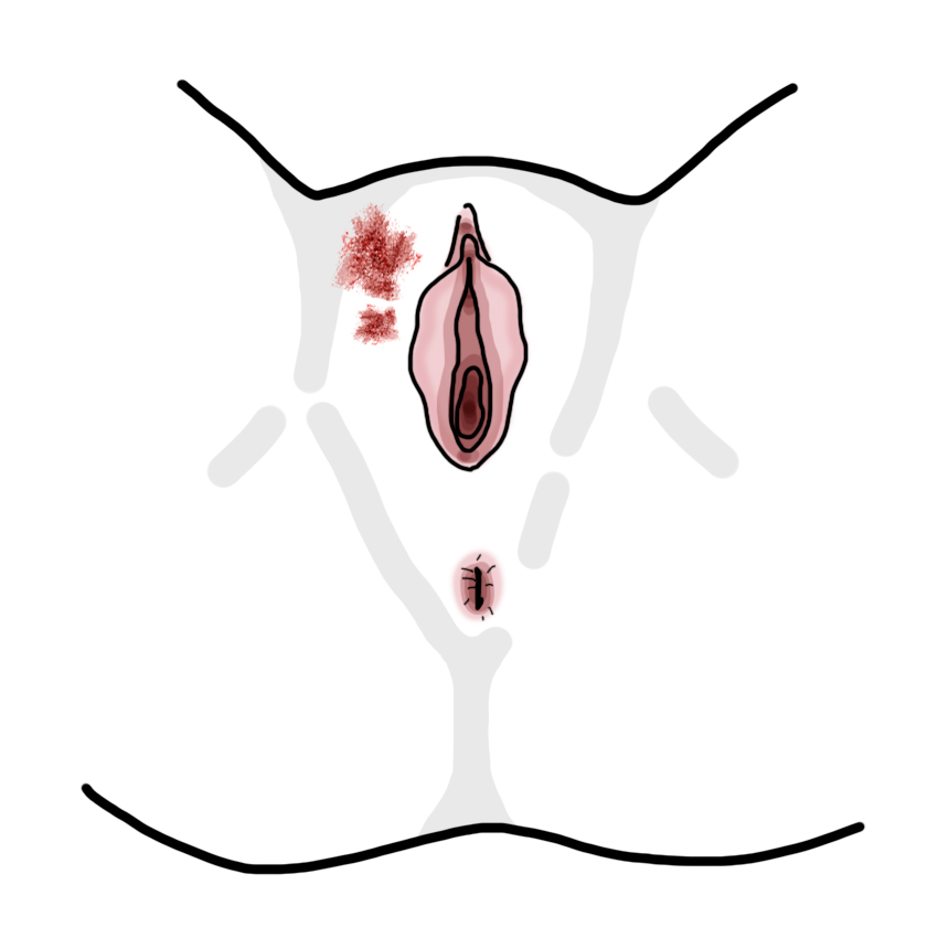 Vulva burn