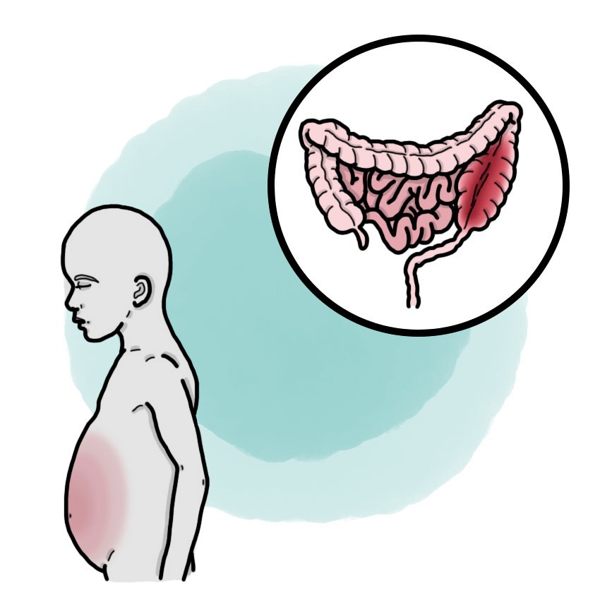 Hirschsprung's disease (Paediatrics)