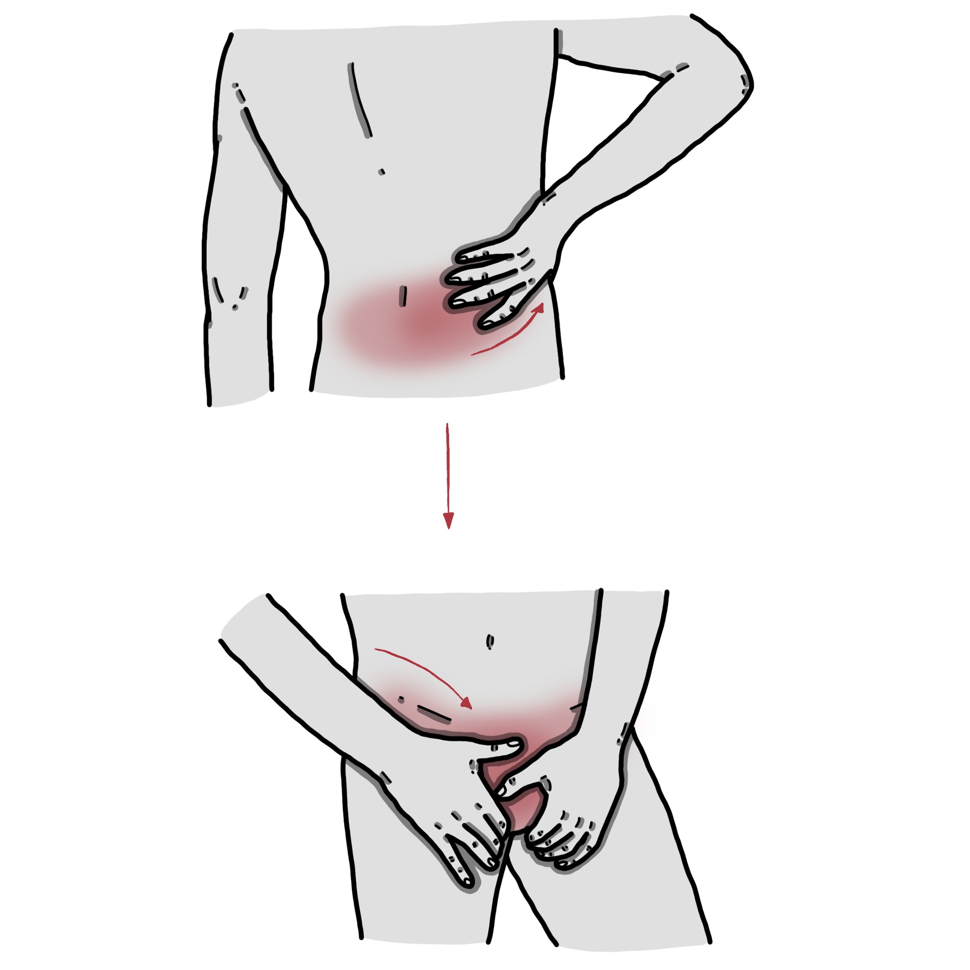 Dolor lumbar irradiado a ingle y/o genitales