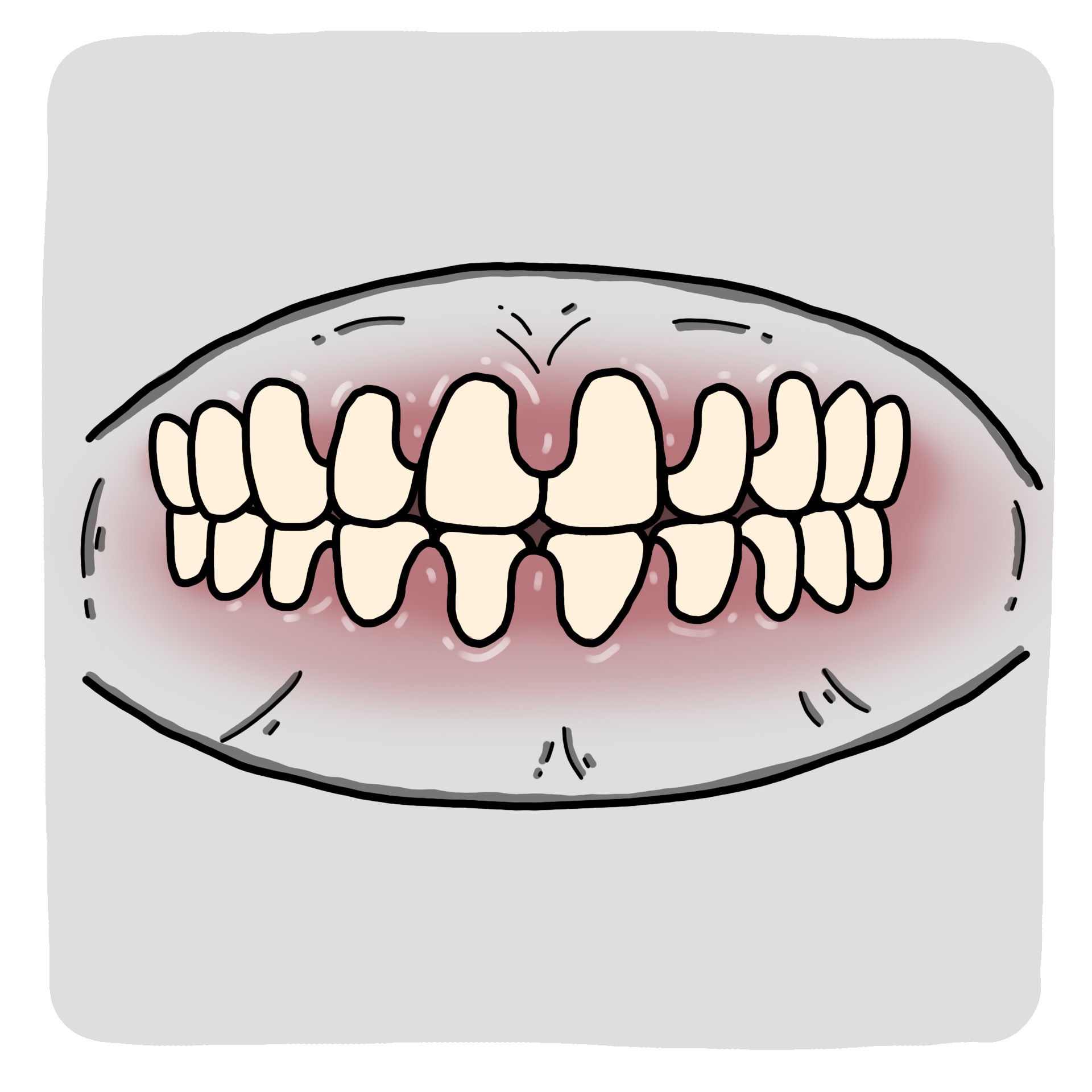 Hipertrofia gingival