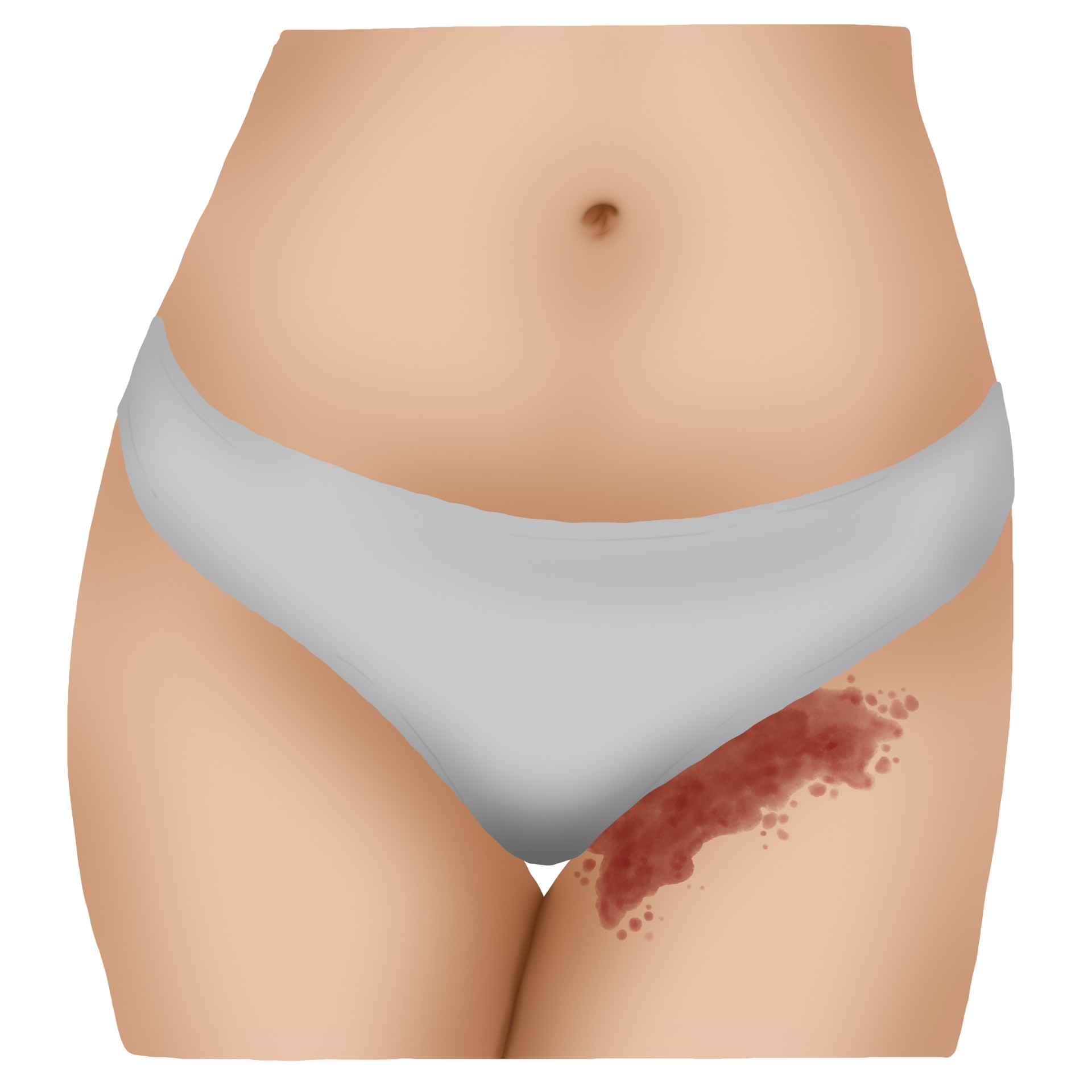 Rougissement du pli de la région inguinale