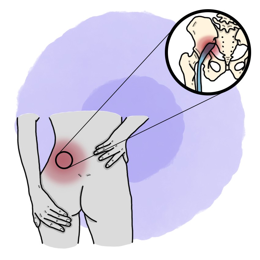 Sciatica - Lumbosciatalgia