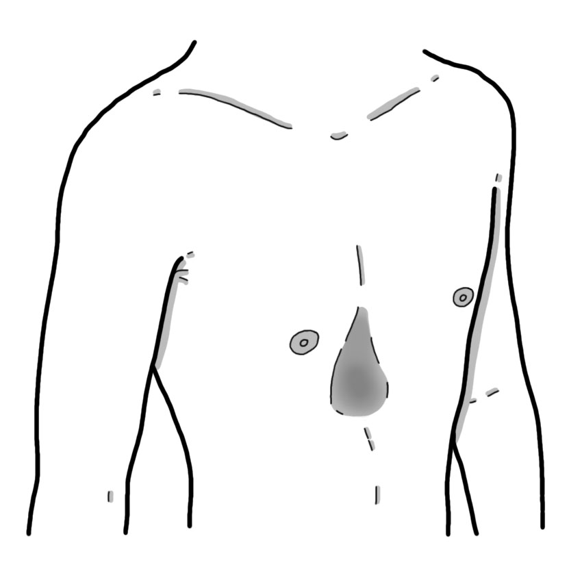 Funnel chest - Pectus excavatum - Pectus excavatum (Paediatrics)