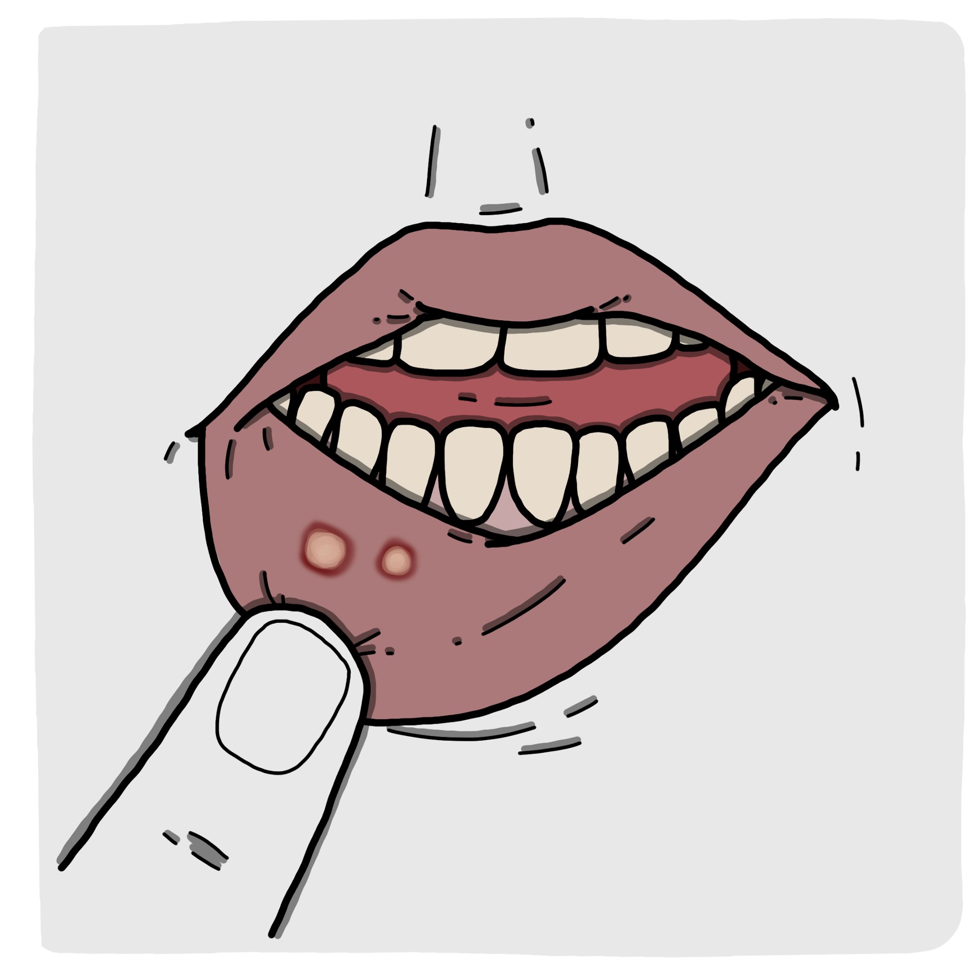 Canker sore - Oral aphtha