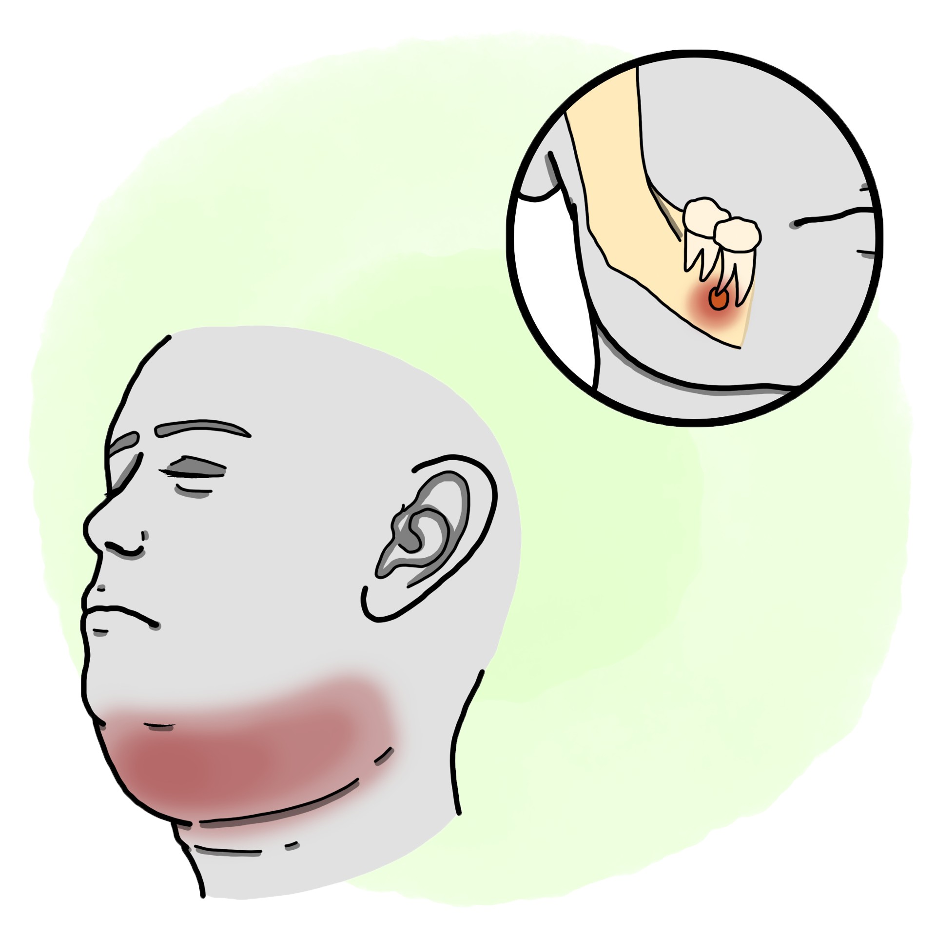 Abscess on the floor of the mouth - Ludwig's angina