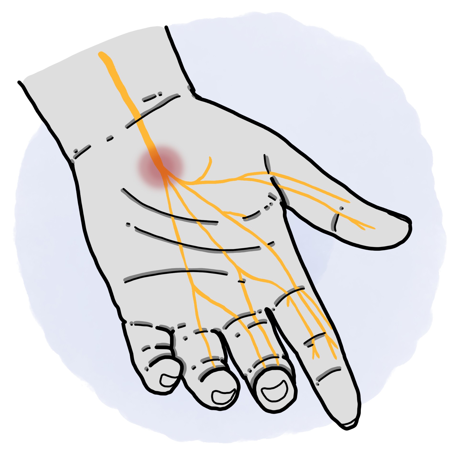Carpal tunnel syndrome