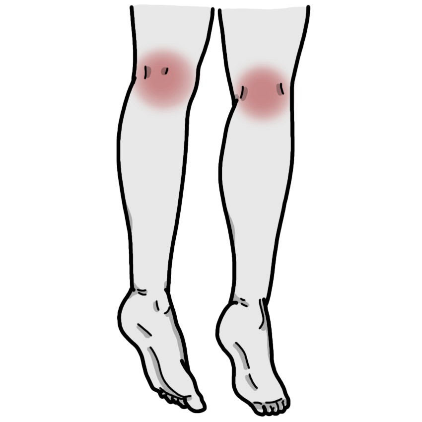 Schmerzen in der Kniekehle