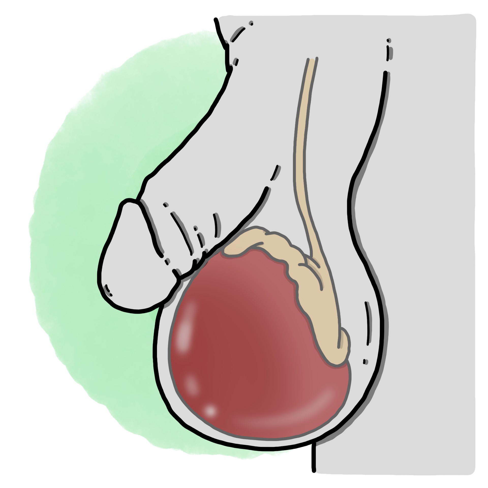Epididymitis - Orchiepididymitis (Paediatrics)