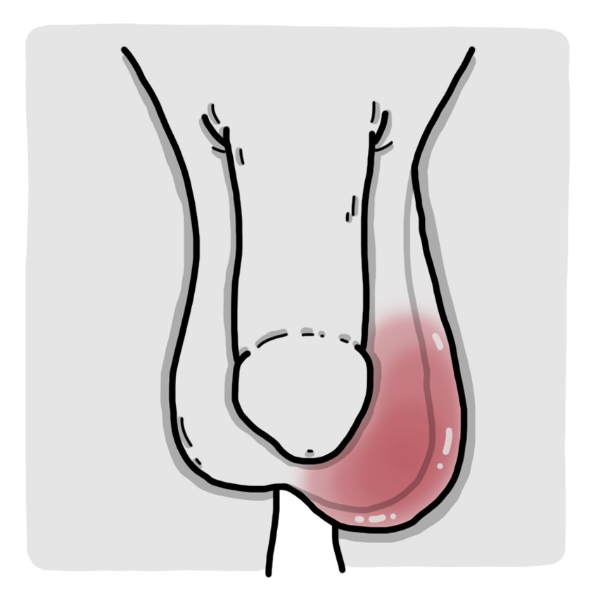 Testicule sensible, enflammé et/ou sensation de lourdeur