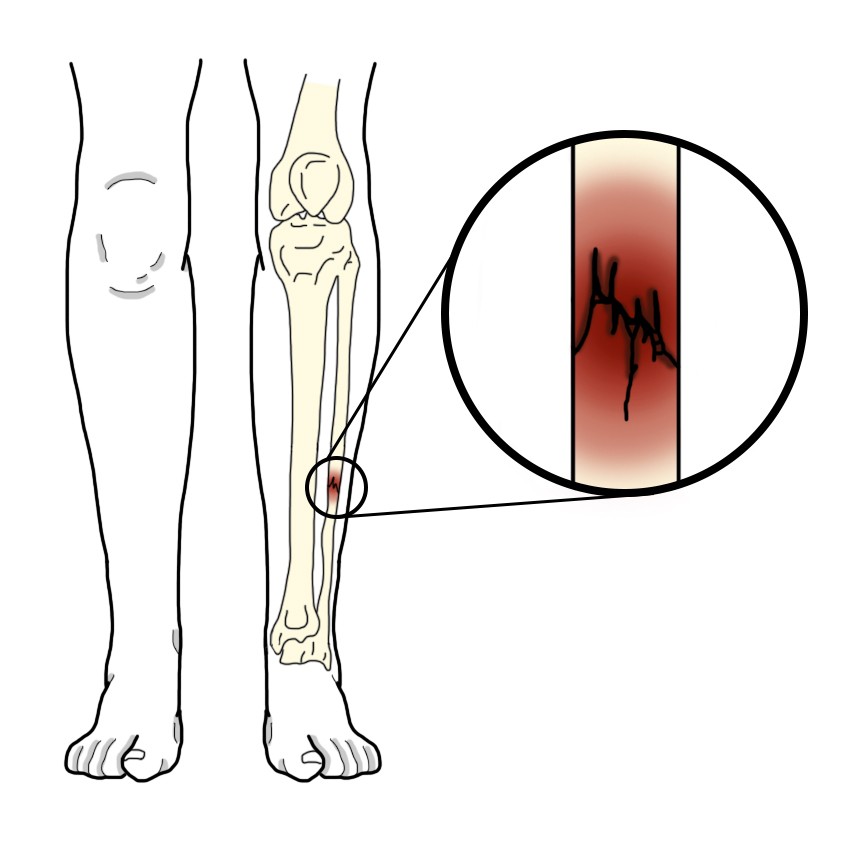 Fibula fracture