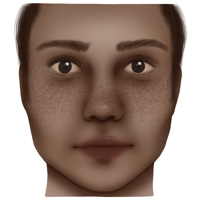 Pregnancy mask - Melasma - Melasma