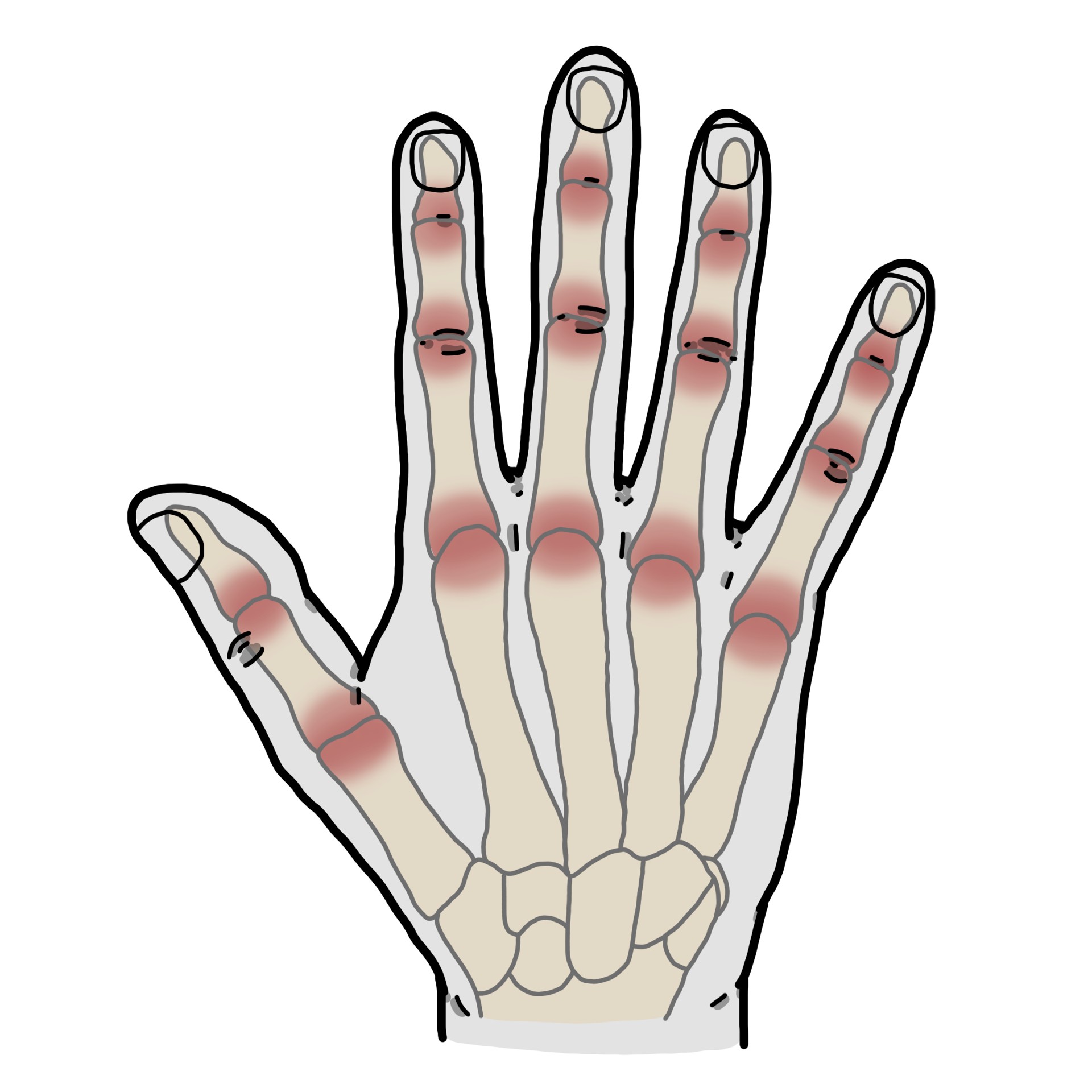 Dolor en las articulaciones de dedos de la mano