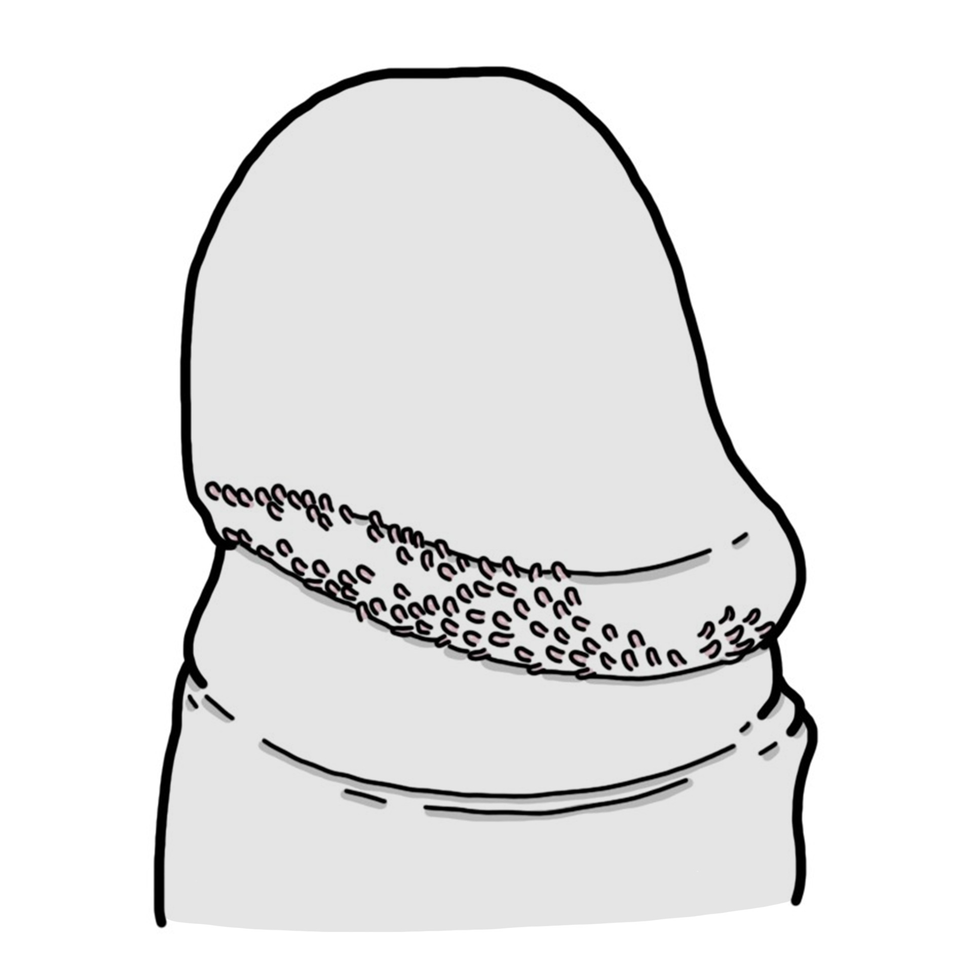 Pápulas perladas en glande