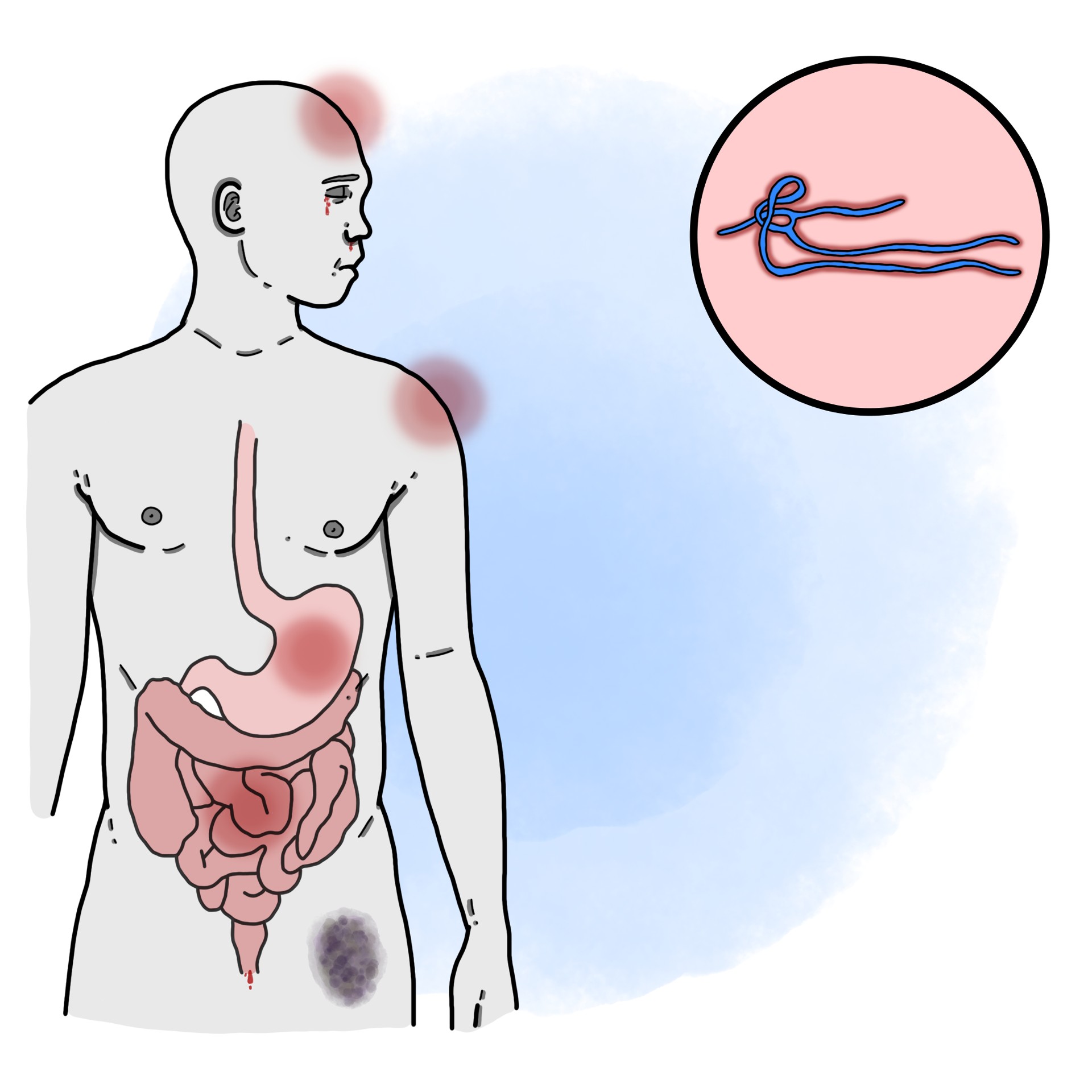 Ebola virus infection - Viral haemorrhagic fever
