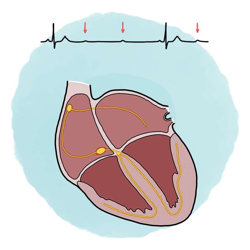 Second-degree atrioventricular block: Mobitz type II