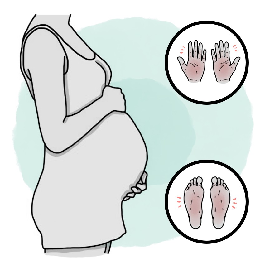 Pregnancy cholestasis - Intrahepatic cholestasis of pregnancy