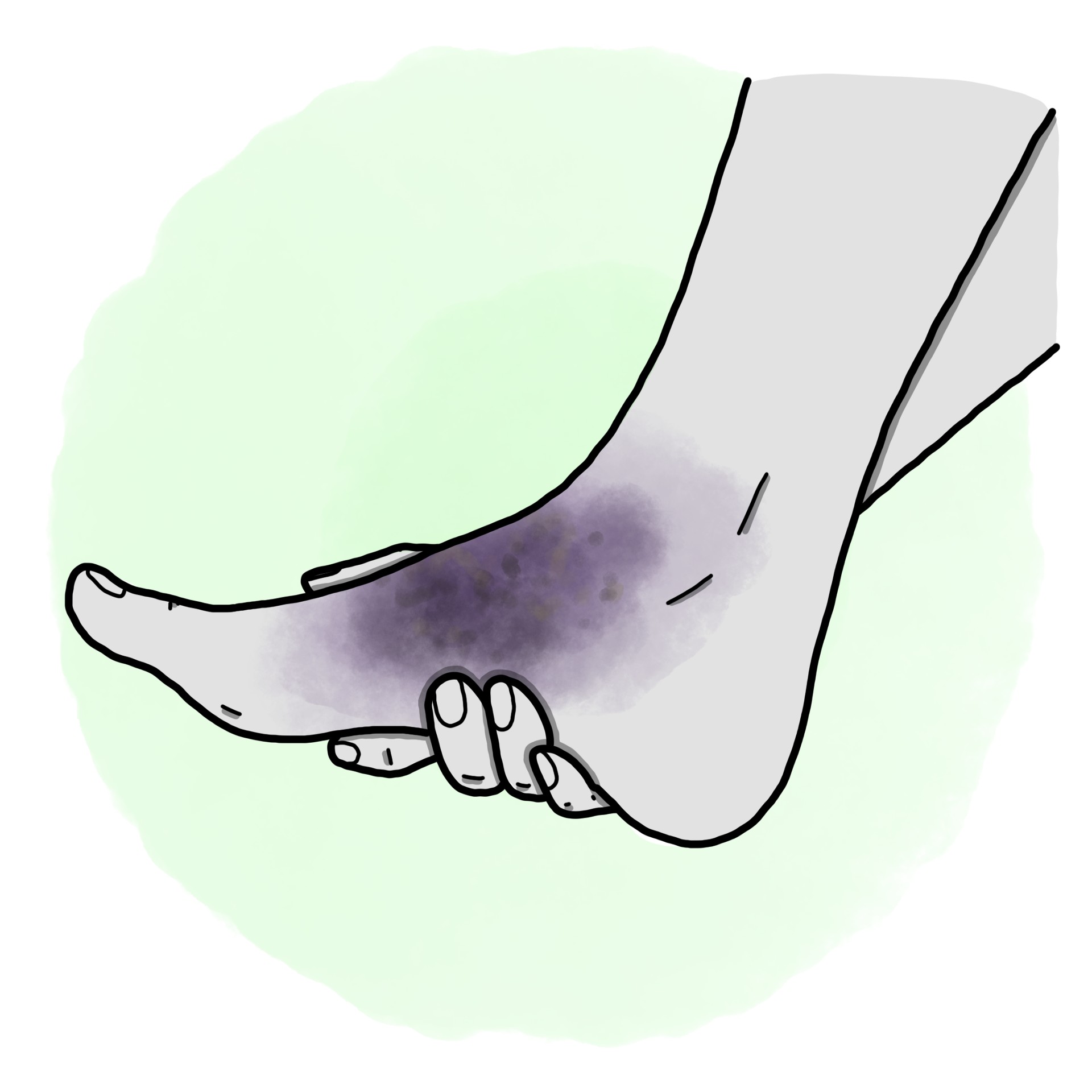 Foot trauma - Foot contusion